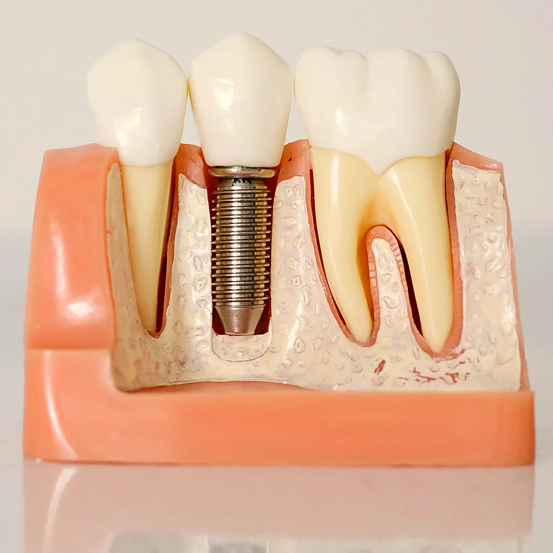 Modelo odontológico em corte mostrando um implante dentário: o pino de titânio rosqueado instalado no osso, com a coroa acima da gengiva, ao lado de dentes naturais com suas raízes