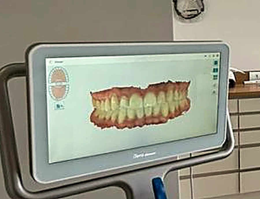 Tela do escâner intraoral iTero exibindo o modelo digital tridimensional da arcada do paciente